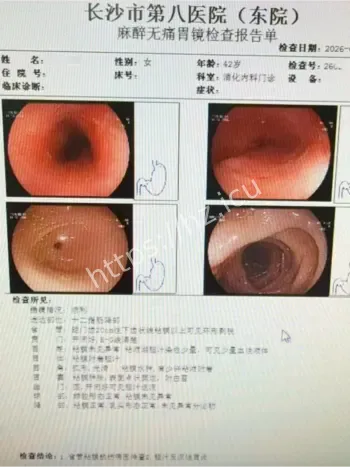 吃火锅烫出食管溃疡
